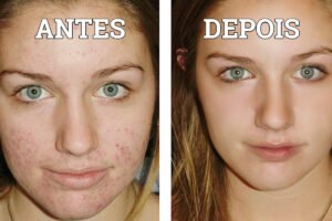 Antes e depois do skin care para espinhas