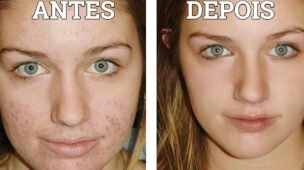 Antes e depois do skin care para espinhas