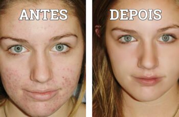 Antes e depois do skin care para espinhas